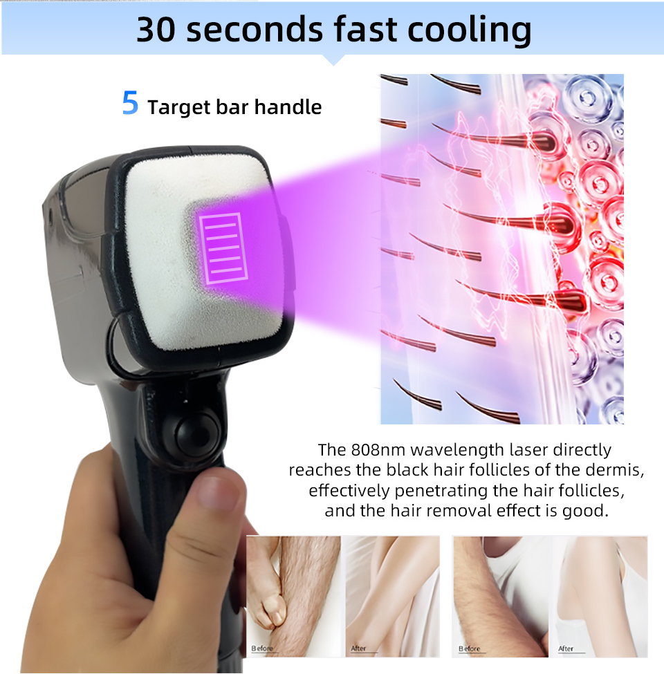 Nouveau style, laser diode por - Industrial Laser Hair Removal Machine avis et prix